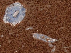 آنتی بادی ایمونوهیستوشیمی IDH1