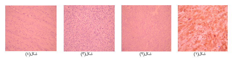 رنگ پذیری p16 در تومور