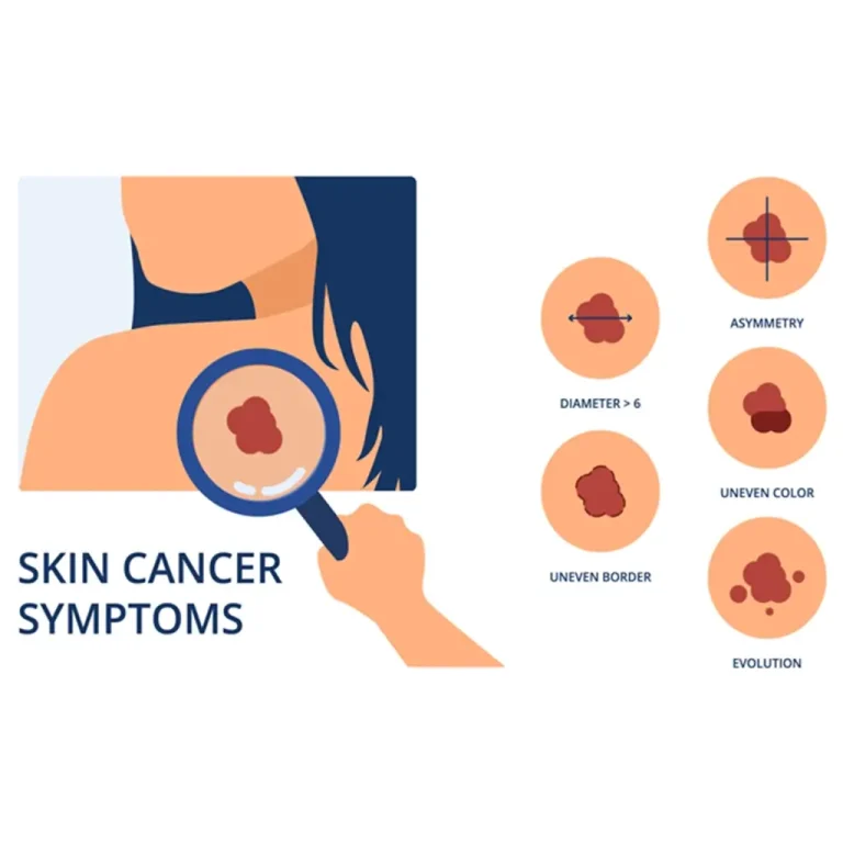 Skin-Cabcer-Symptoms