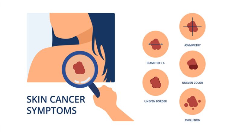 علایم سرطان پوست