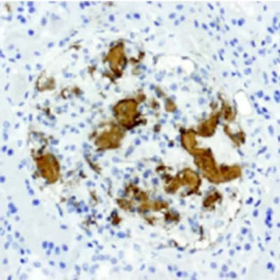 آنتی بادی Amyloid A کلون MC1 برند PathoSage