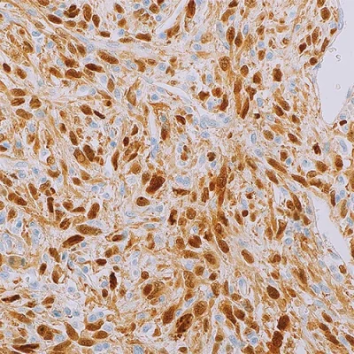 آنتی بادی Cdk4 کلون DCS-35 برند PathoSage