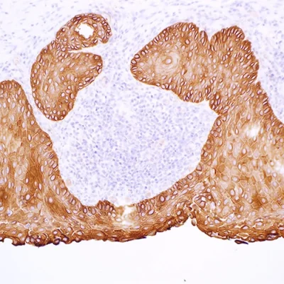 آنتی بادی Cytokeratin 17 کلون EP98 برند PathoSage