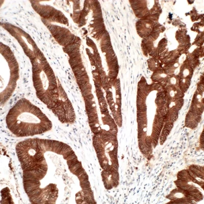آنتی بادی EGFR(Epidermal Growth Factor Receptor) کلون EP22 برند PathoSage