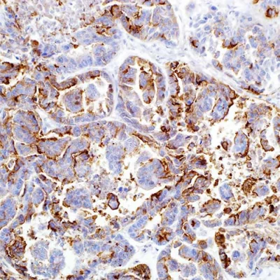 آنتی بادی HBME1 کلون HBME-1 برند PathoSage