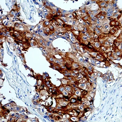 آنتی بادی BRST-2(GCDFP-15) کلون EP95 برند PathoSage