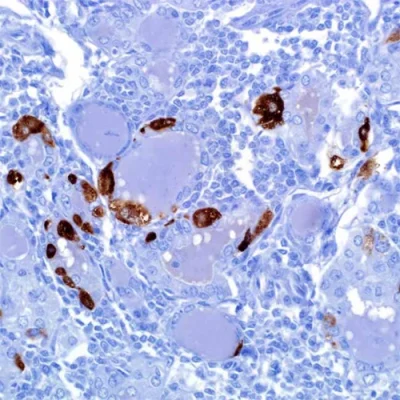 آنتی بادی Calcitonin کلون SP17 برند PathoSage