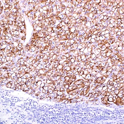 آنتی بادی Carbonic Anhydrase 9 کلون EP161 برند PathoSage