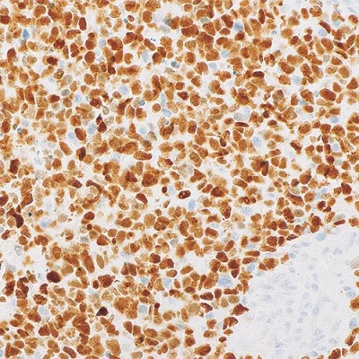 آنتی بادی CEA(Carcinoembryonic Antigen) کلون Polyclonal برند PathoSage