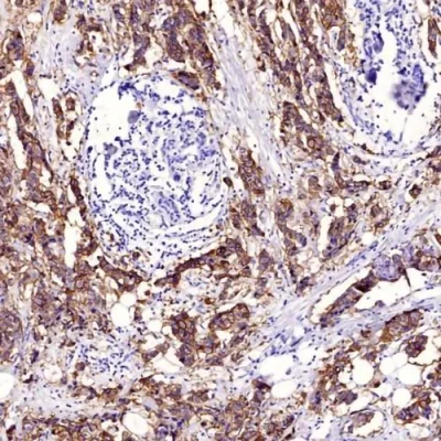آنتی بادی C-erbB-2(HER2) کلون ERBB2/4439 برند PathoSage
