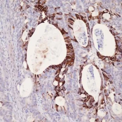 آنتی بادی Cytokeratin 20 کلون E19-1 برند PathoSage