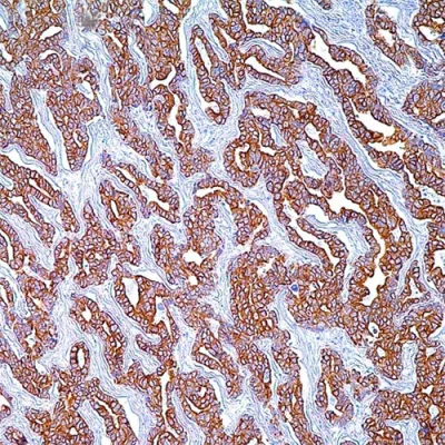 آنتی بادی Cytokeratin Cocktail کلون AE1+AE3 برند PathoSage