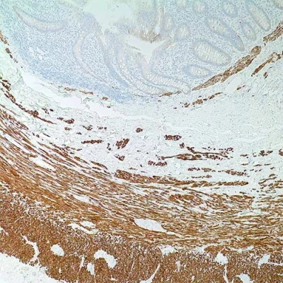 آنتی بادی Desmin کلون D33 برند PathoSage