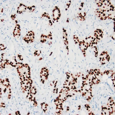 آنتی بادی ER(Estrogen Receptor) کلون ZR2 برند PathoSage