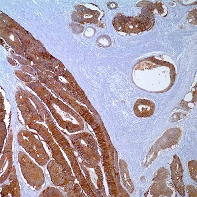 آنتی بادی ESA(Epithelial Specific Antigen) کلون MOC-31 برند PathoSage