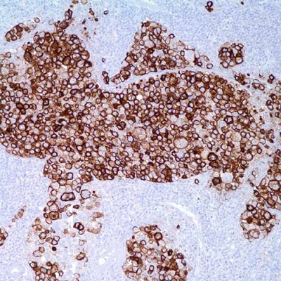 آنتی بادی Melanoma کلون HMB45 برند PathoSage