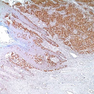 آنتی بادی MITF(Microphthalmia-Associated TranscriptionFactor) کلون C5+D5 برند PathoSage