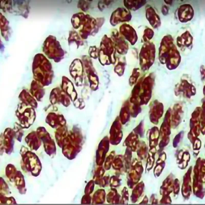 آنتی بادی MSH2 کلون G219-1129 برند PathoSage