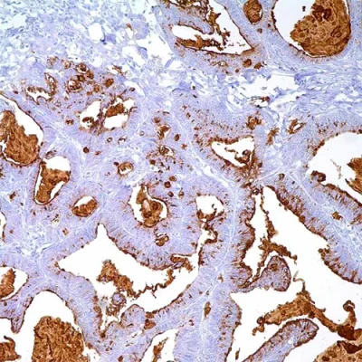 آنتی بادی BRST-3(TAG72) کلون B72.3 برند PathoSage