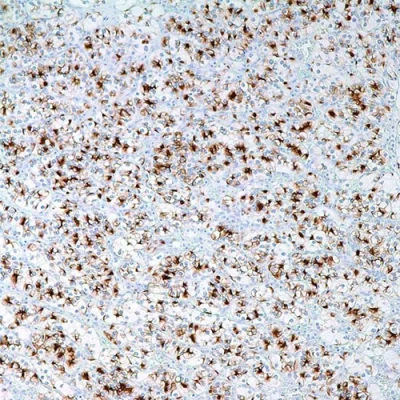 آنتی بادی RCC کلون PN-15 برند PathoSage