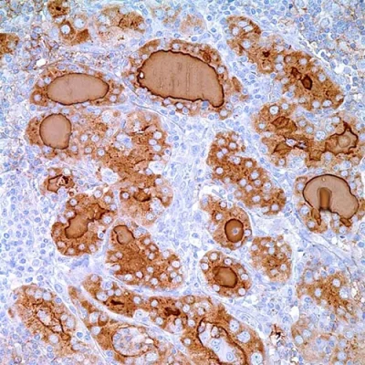آنتی بادی Thyroglobulin کلون 2H11+6E1 برند PathoSage