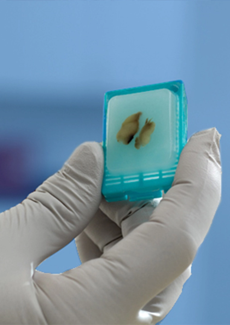 نحوه پارافینه کردن بافت‌ نمونه سرطانی